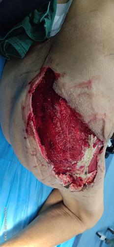 臀部蜂窝组织炎的治疗