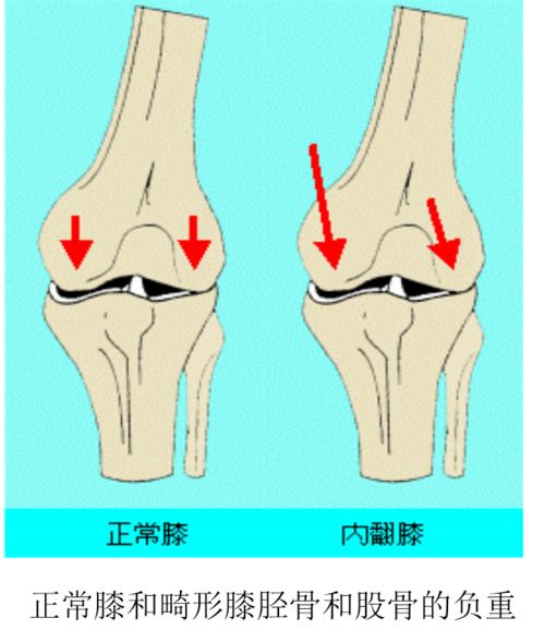 足球运动员膝关节损伤的生物力学分析