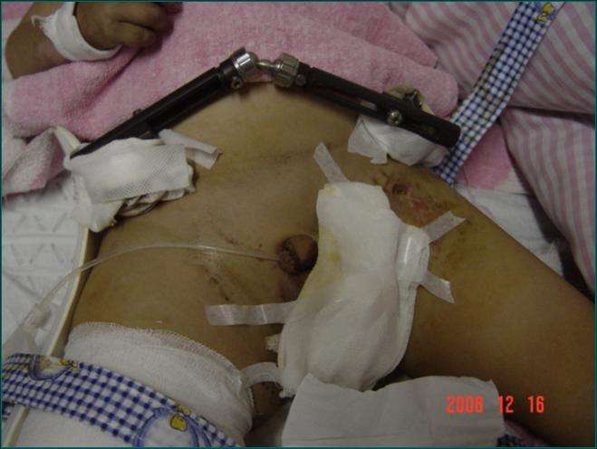 骨盆粉碎性骨折 失血性休克患儿抢救过程