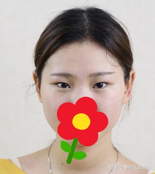 吊眼单眼皮:不同程度的吊眼需要不一样的处理(1)