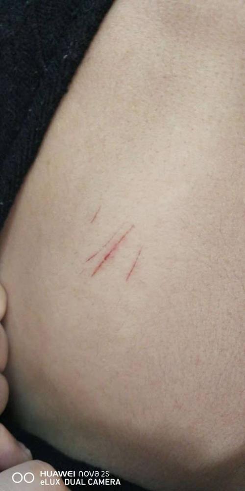 身上莫名其妙的有划痕抓痕?