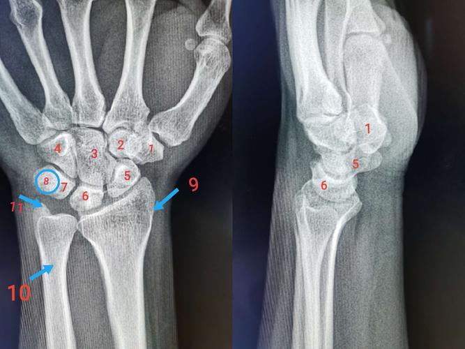 小多角骨 3.头状骨 4.勾状骨 5.舟状骨 6.月状骨 7.三角骨 8.