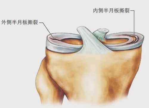 是半月板最常见的损伤,见于半月板外缘,中间,内缘或两端(前角或后角)