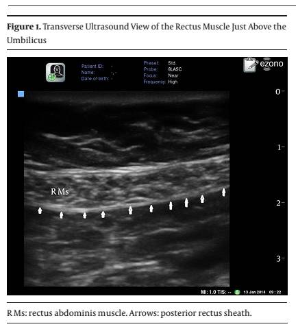 不妨来一发腹直肌鞘阻滞!