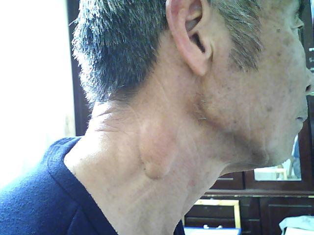 脂肪瘤要做哪些检查_肿瘤科_阿里康网