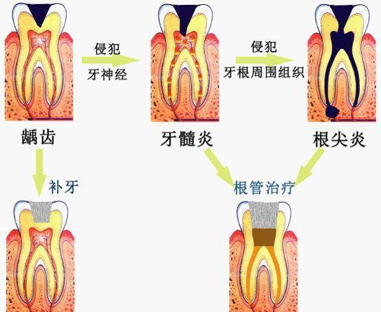 春节口腔急症处理指南(蛀牙,牙疼)|牙髓炎|冠周炎|炎症|牙周病|牙周炎