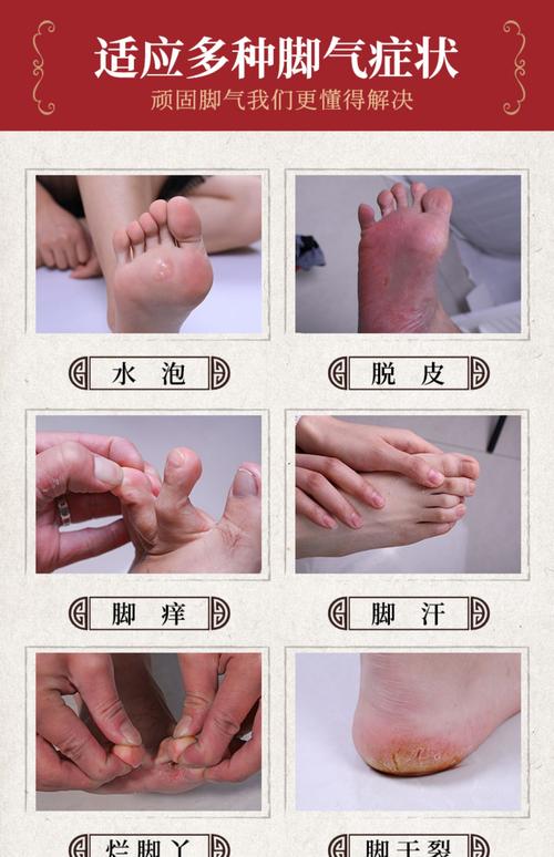 本草脚气喷剂止痒膏脱皮脚丫脚臭脚痒泡脚水烂抑菌杀菌除水泡有什么用