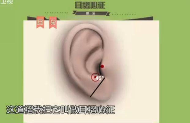 25岁孙侨潞饮酒心梗去世,被网友科普耳褶心征吓得摸了100遍耳朵