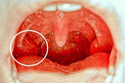 扁桃体是一堆扁卵圆形的淋巴器官,它藏匿于扁桃体窝内,腭咽弓和