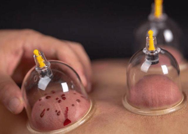 拔火罐时,后背出来的瘀血,是排出的毒素吗?多数人可能