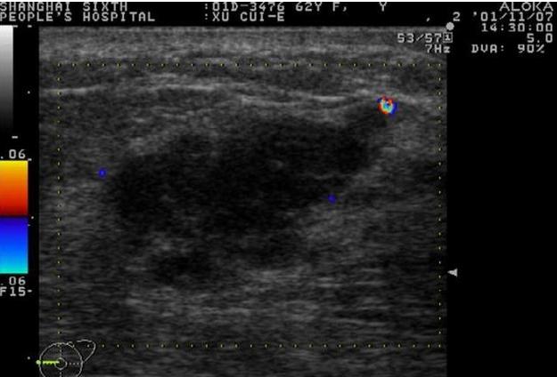 规则,椭圆形的良性肿瘤首先需要看结节的大小和形状,如果结节比较小