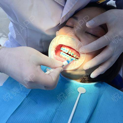 牙齿矫正手术当天_牙齿美容手术当天_悦mer_5217102746分享图片9