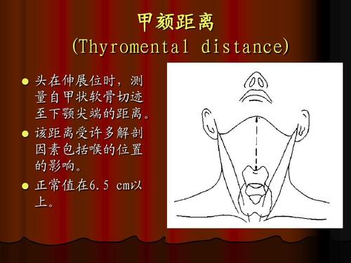 文档网 所有分类 医药卫生 临床医学 气管插管技术ppt  甲颏距离