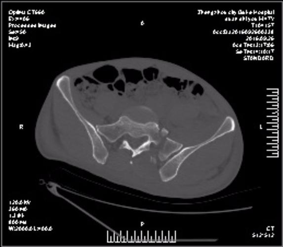 其它 骶骨骨折两例病例分享 术前ct