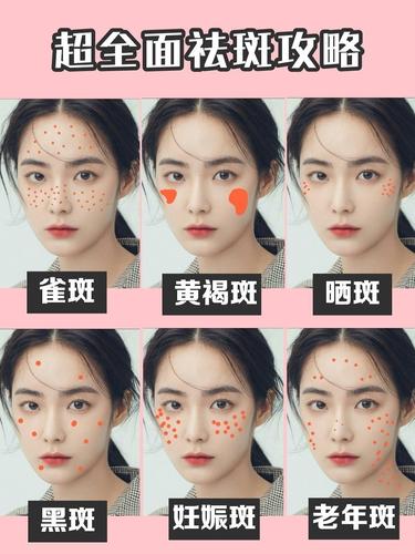 想祛斑首先清楚你是属于什么类型的斑