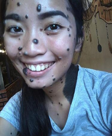 女子全身长满黑痣,如今可能成为环球小姐!