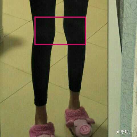 大腿膝盖骨突出?