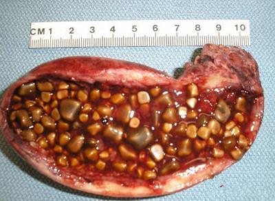 为什么人身体里石头变多了?_胆结石_健康资讯 - 名医在线