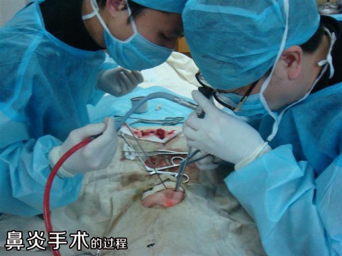 鼻炎手术的恐怖照片,胆小者勿入