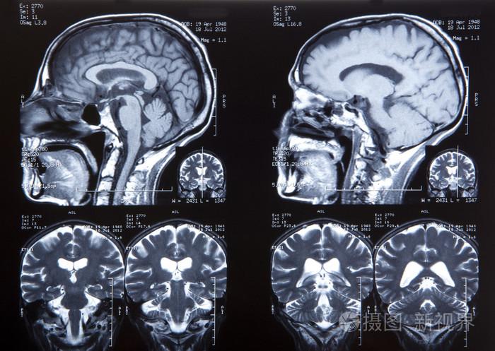 人类的大脑磁共振成像