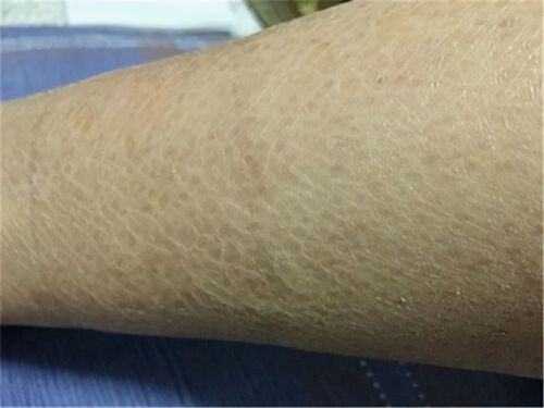 01 蛇皮肤:寻常型鱼鳞病 蛇皮肤,是一种遗传性皮肤病,一般三岁左右