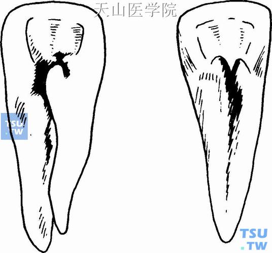 临床分类 畸形舌侧窝 舌侧窝呈囊状深陷,利于致龋菌滋生,同时囊底