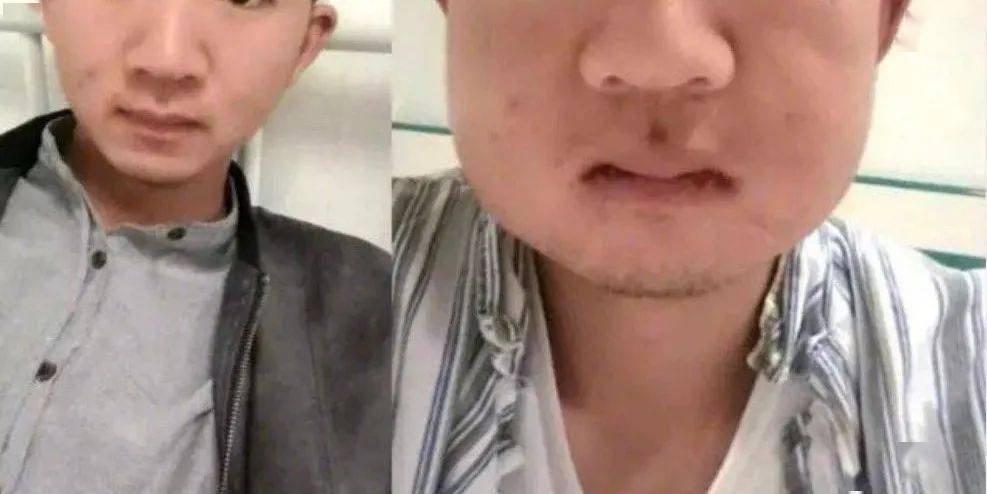 这些明星拔完智齿后,脸竟然变成这样,智齿到底该不该拔?