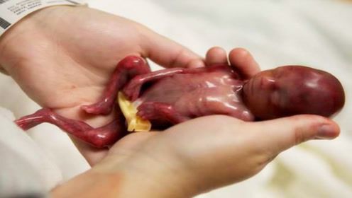 人工流产的胎儿遗体,医院会怎样处理?从业多年医生解开幕后真相