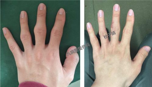 厚皮指症近侧指间关节粗大