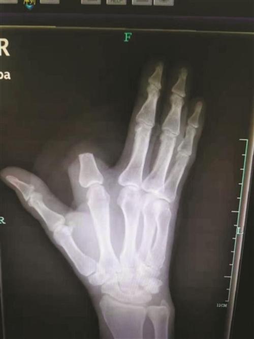 患者的x光片.图片由杭州市中医院提供