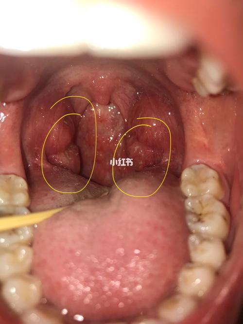 扁桃体结石(图3很吓人)_口臭_棉签_医疗健康_医疗健康