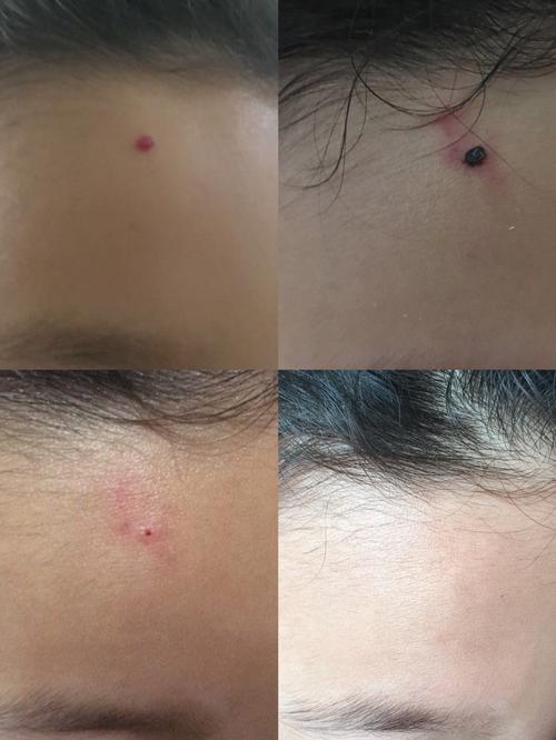 爱出血的血管瘤肉芽肿性血管瘤