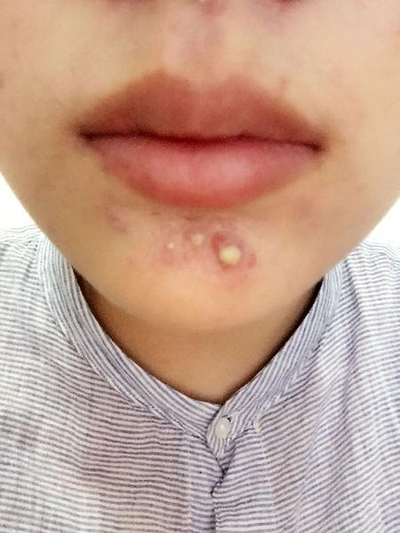我的下巴长痘好几年了,好大的脓包的痘痘,我饮食习惯不好,不喜欢喝