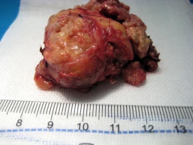 神经导航全切罕见复发性脑室内脑膜瘤