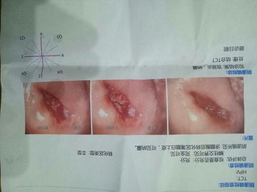 今天做了一个阴道镜检查,鳞拄交界可见:完全可见,转化区类型ii型涂