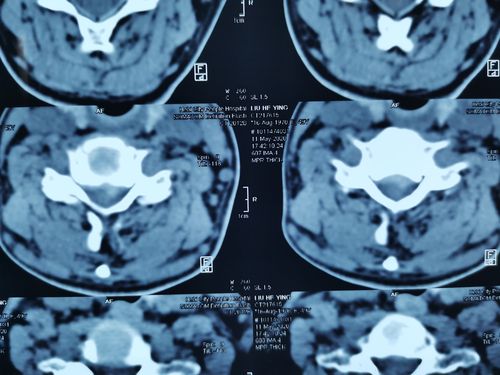 颈椎ct:颈5-6椎体后缘显示弧形软组织影.