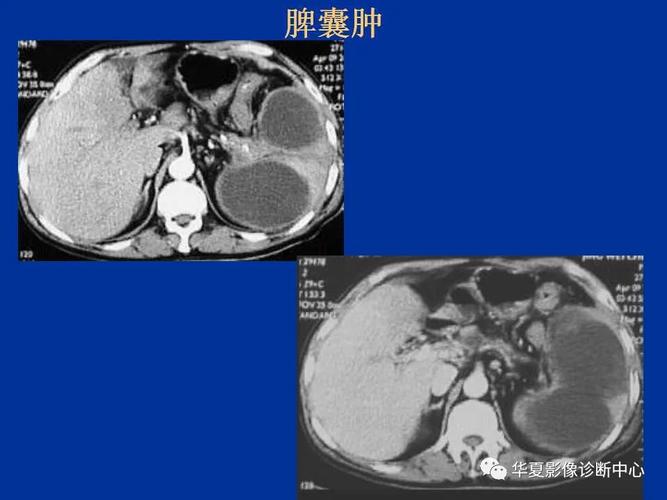 脾脏疾病的ct诊断