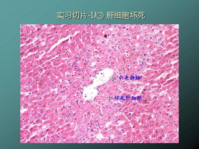 实习切片-ij③肝细胞坏死