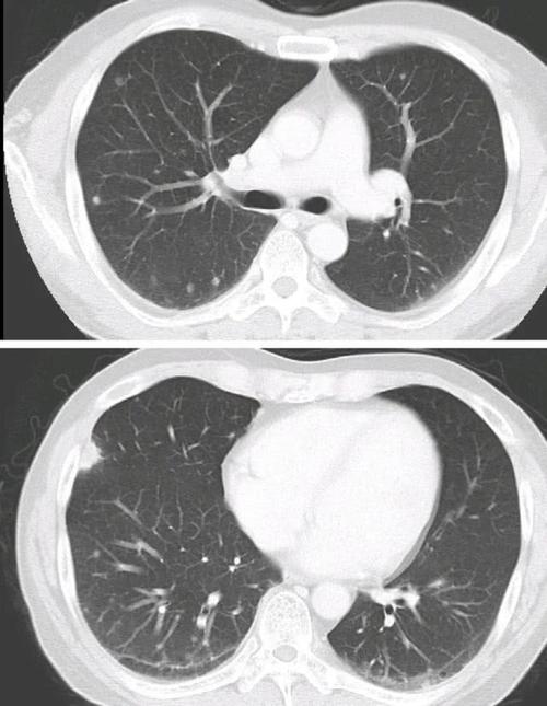 ct示两肺多发结节(isobe t, et al. intern med. 2019)