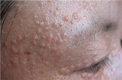 湿疹样癌"样方式真皮内某些瘤巢位于扩大的淋巴管内提示肿瘤在皮肤