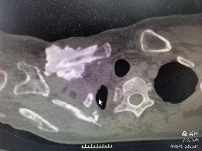 乳癌成骨性骨转移