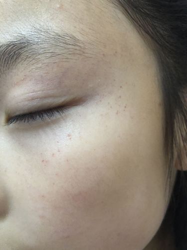 八岁孩子脸上皮下出血点是怎么回事