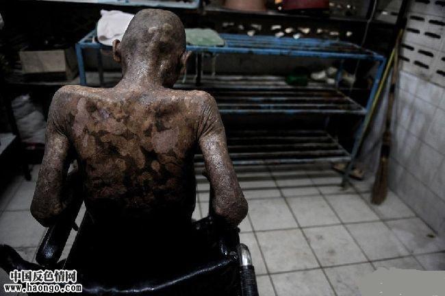 处于晚期的艾滋病人,大多活不过一周