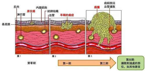 原位癌和癌症的区分兼谈保险理赔