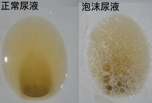 但是当尿酸盐晶体沉积到肾脏,影响肾功能,那么就有可能产生蛋白尿