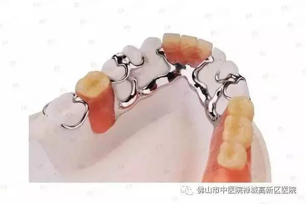 无论单个牙缺失,多个牙缺失或全口牙缺失都可以选择活动假牙修复