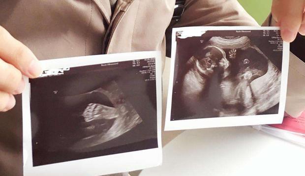 原创产检时胎儿在肚子里动来动去医生一脸严肃这孩子要不得