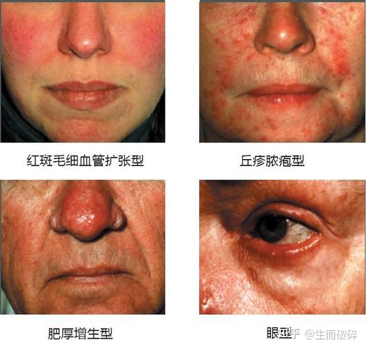 玫瑰痤疮终极科普