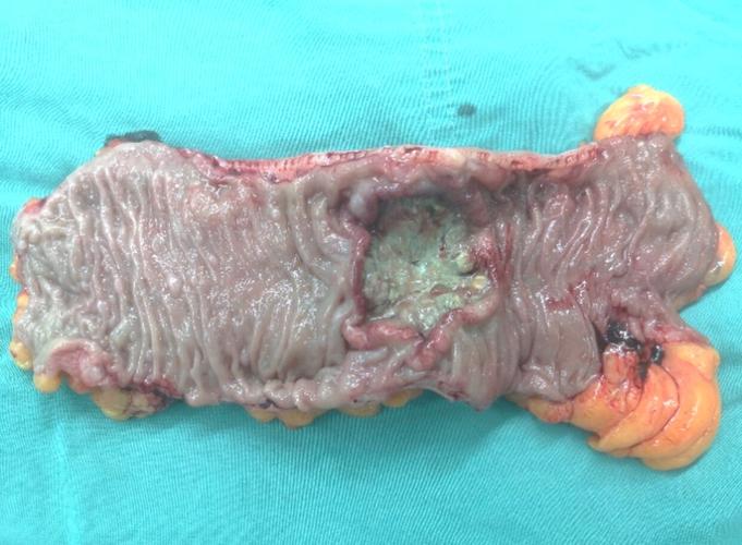 结直肠癌是可防可治的懒癌