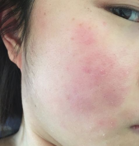 我的皮肤算是比较细腻的,生平从未对化妆品过敏,偶尔会有一两个粉刺痘